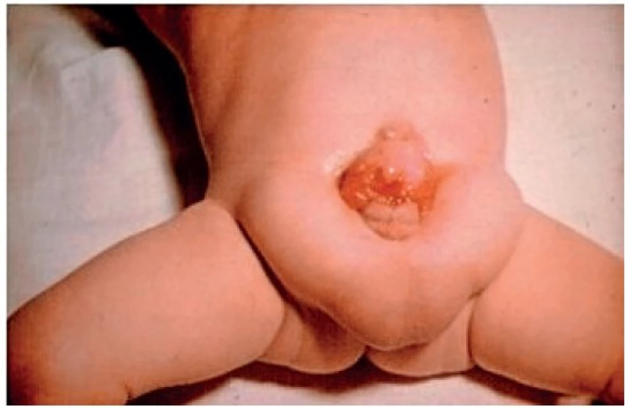 Nativní exstrofie močového měchýře se skrotálnímiherniemi a již částečnou metaplazií sliznice exstrofickéhoměchýře.
Fig. 1. Exstrophy of the urinary bladder with scrotal hernias and partial metaplastic changes of the bladder mucosa.