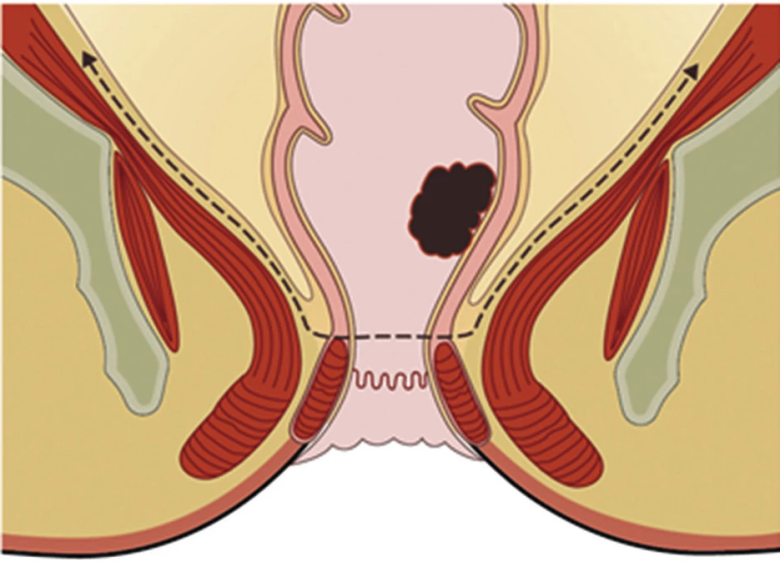 Princip „down to up“ TME po protětí rekta 
Fig. 3: Principle of „down to up“ TME after cutting a rectum
Autor: T. Grolich ve spolupráci se Servisním střediskem pro e-learning na MU
Autor: T. Grolich