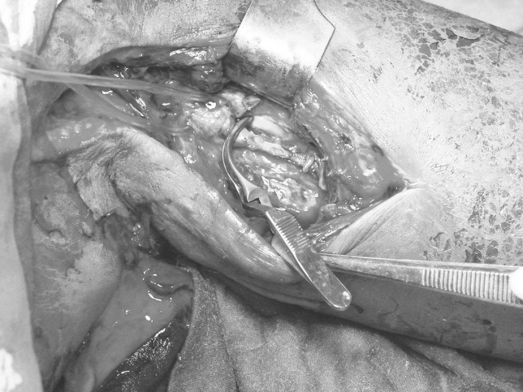 Pseudoaneuryzma proximální části arteria brachialis. Defekt ventrální stěny arterie v popisované délce 3 cm
Fig. 1. Brachial artery pseudoaneurysm. Defect of a ventral aspect of the arterial wall is 3 cm long