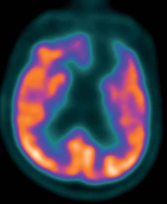 Subtrakční zobrazení FDG PET/CT před podáním zolpidemu.
Fig. 1. Subtraction FDG PET CT scan prior to zolpidem administration.