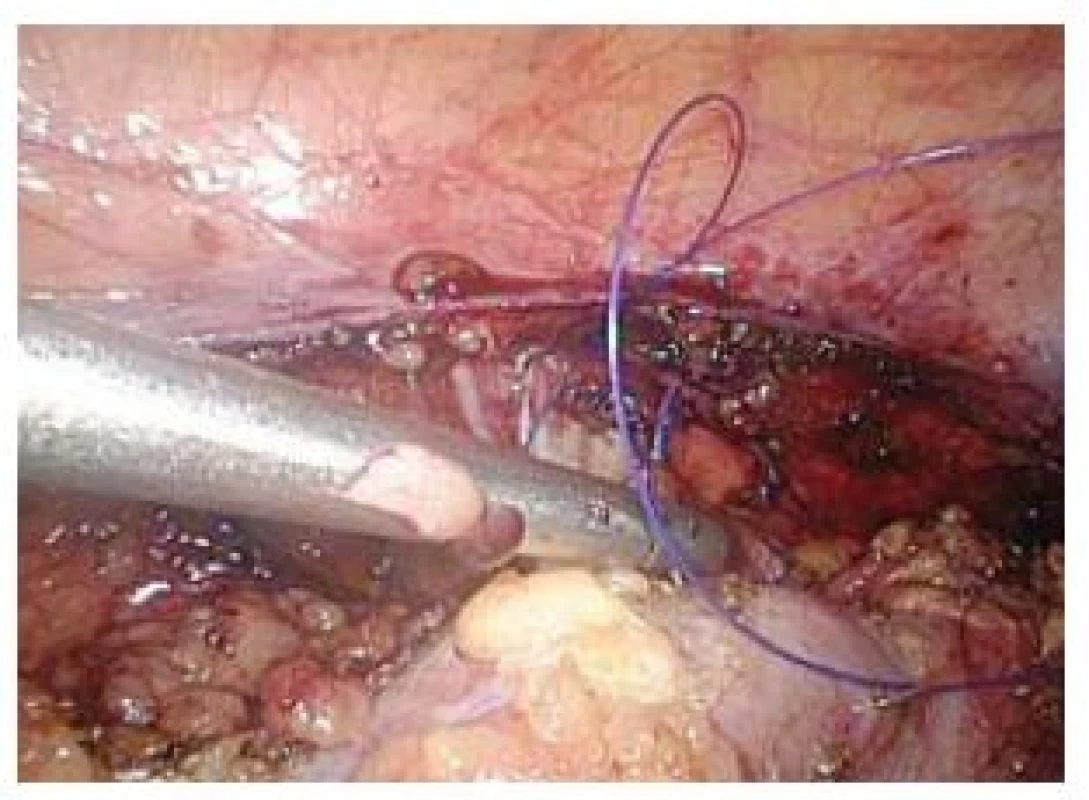 Jehla zapíchnutá v pravé ledvině
Fig. 4. Needle digged in the right kidney