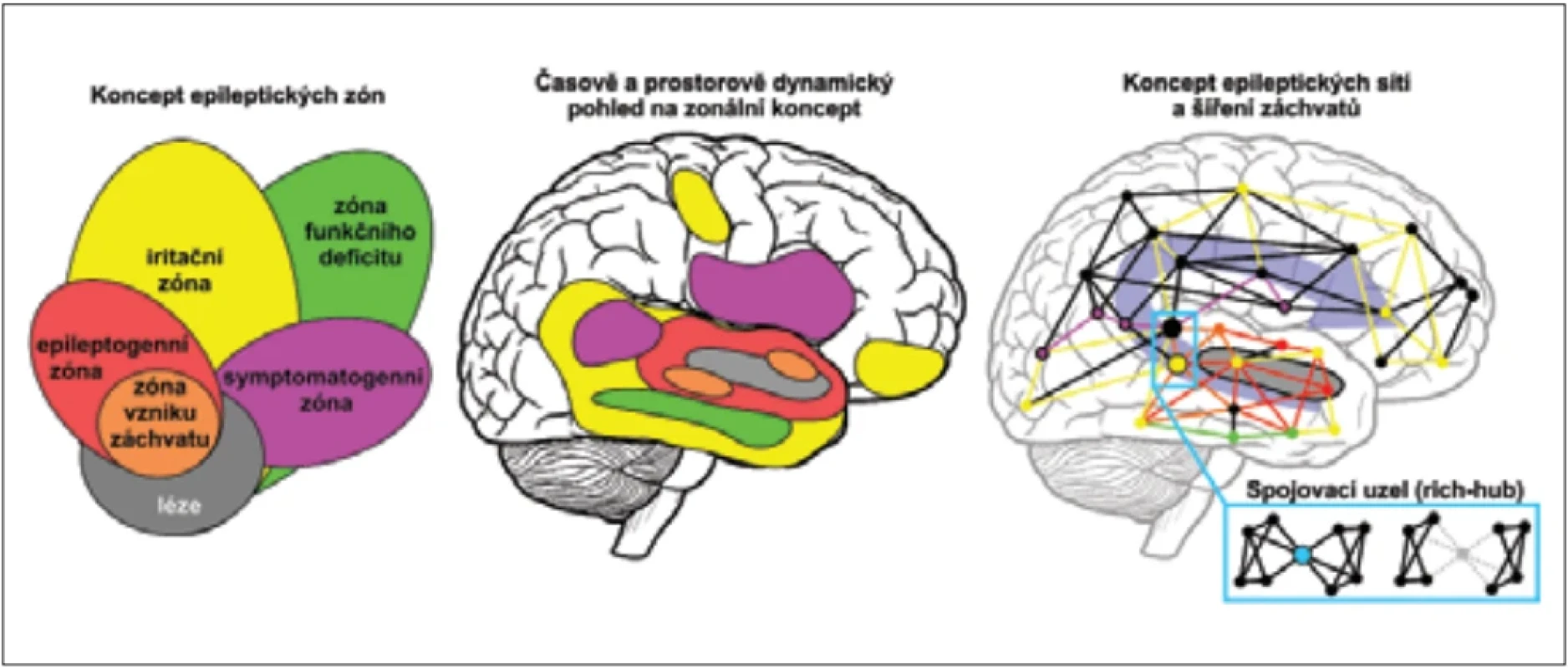 Vývoj konceptu předoperační diagnostiky od kortikálních zón k epileptickým sítím. Kortikální zóny mohou reprezentovat rozsáhlou vnitřně dynamicky interagující síť, přičemž určení přesné hranice zón často není možné: jednotlivé zóny mohou být prostorově nehomogenní a vnitřně se dále dělit [44]. V konceptu sítí lze identifi kovat tzv. spojovací uzly (rich-hubs), jež propojují menší podsítě do větších sítí. Přerušením v místě spojovacího uzlu je narušena cesta šíření záchvatové aktivity, ideálně dochází k odpojení epileptogenní sítě od zbytku mozku. Fig. 2. Evolution of the presurgical diagnostic concept from cortical zones to epileptic networks. Cortical zones may represent an extensive, internally dynamic and interacting network, and it is often not possible to determine their precise boundaries: individual zones may be spatially inhomogeneous and further subdivided internally [44]. Within the network concept, so-called rich hubs can be identifi ed – connection nodes that link smaller subnetworks into larger networks. Disrupting a rich hub can interrupt the pathway of seizure propagation, ideally resulting in the disconnection of the epileptogenic network from the rest of the brain.