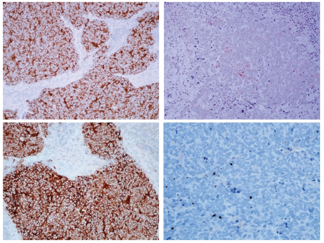 Imunohistochemický nález.