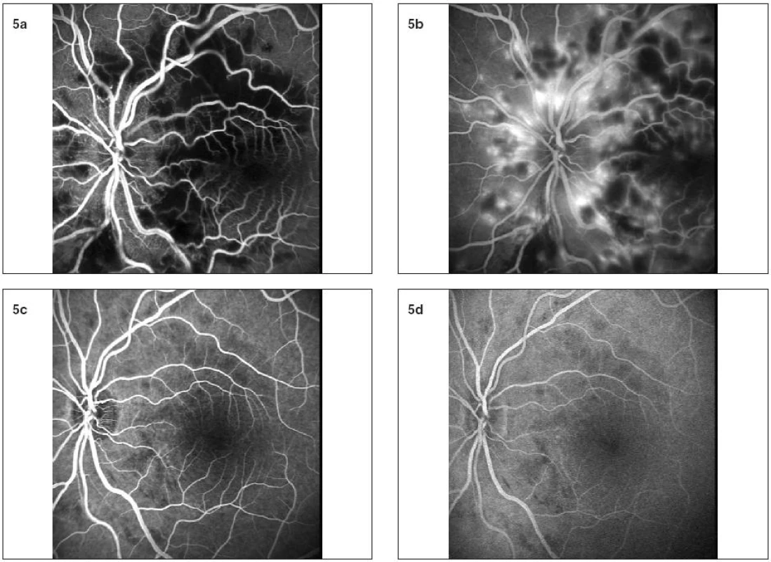 a, b. Na fluoresceínovej angiografii ľavého oka v skorej fáze pozorujeme hypofluorescenciu spôsobenú nedostatočným plnením kapilár i výrazne blokovanú hypofluorescenciu v mieste „cotton wool spots“. V neskorých fázach vidno oblasti hyperflourescencie s presakovaním. c, d: Po 6 týždňoch vymizli rozsiahle oblasti kapilárnej neperfúzie i hyperflourescencie, avšak ešte pretrvávajú drobné oblasti hypofluorescencie
