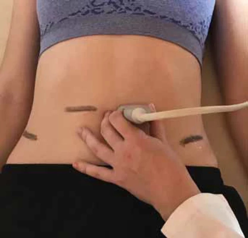 a. Pozice sondy pro měření lineárního rozměru přímého břišního svalu. Fig. 1a. Probe position for measuring the linear parameter of the rectus abdominis muscle.