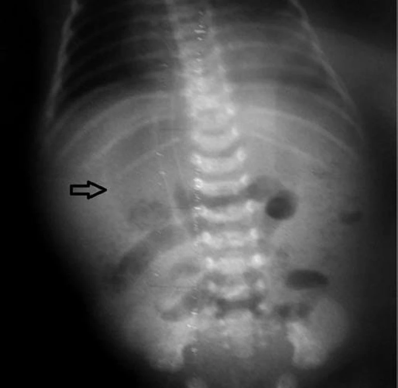 Pneumoperitoneum – voľný vzduch viditeľný ako prejasnenie okrúhleho tvaru nad tieňom pečene.
Fig. 2. Pneumoperitoneum – free air is visible as clearing of round shape above the shadow of liver.
