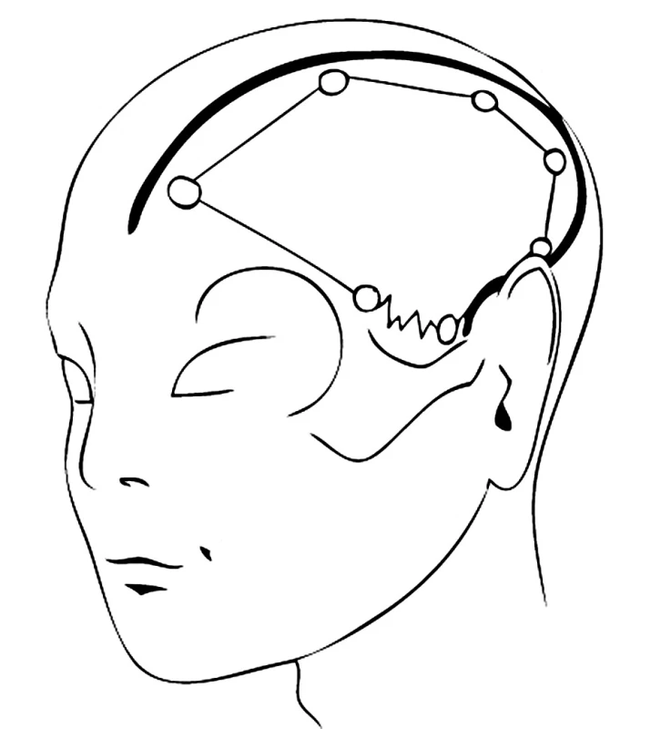 FTPO kožní řez začínající před tragem
Pic. 4. FTPO skin section, originating frontally to the tragus