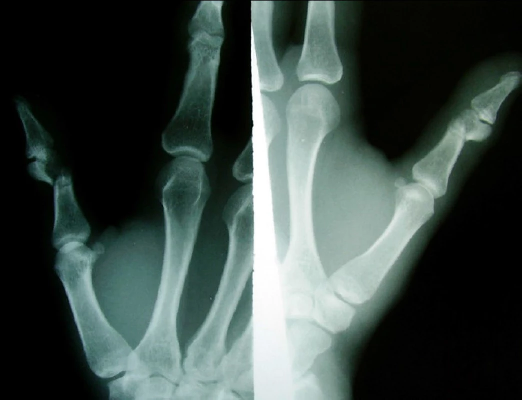 Extraartikulární zlomenina distální epifýzy (a) s osteosyntézou Kirschnerovými dráty (b)