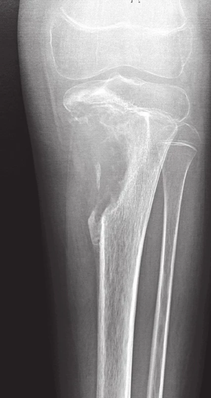 Konvenční high-grade osteosarkom proximální tibie.