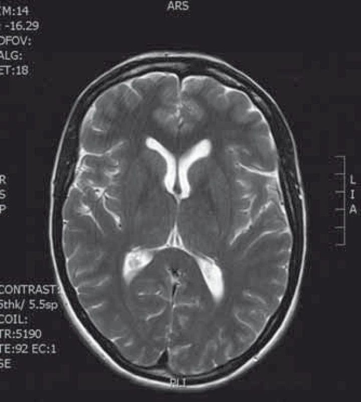 MR vyšetření 6 měsíců po operaci bez rezidua cysty s ústupem hydrocefalu.
Fig. 3. Follow-up MRI 6 month after a surgery with no residual colloid cyst and no hydrocephalus.