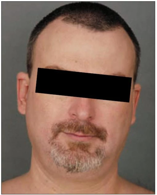 Týž pacient – úplné zhojení projevů v obličeji v rámci léčby PUVA.