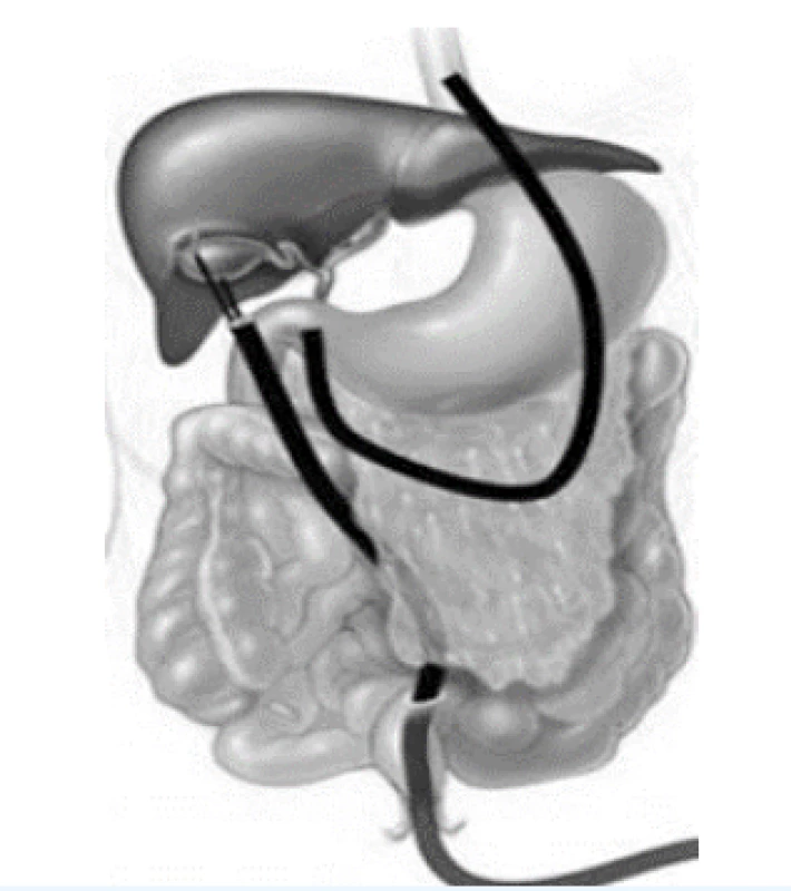 Schéma transanálního a transgastrickéh oendoskopického zákroku Natural Orifice Transluminal Endoscopic Surgery (NOTES)