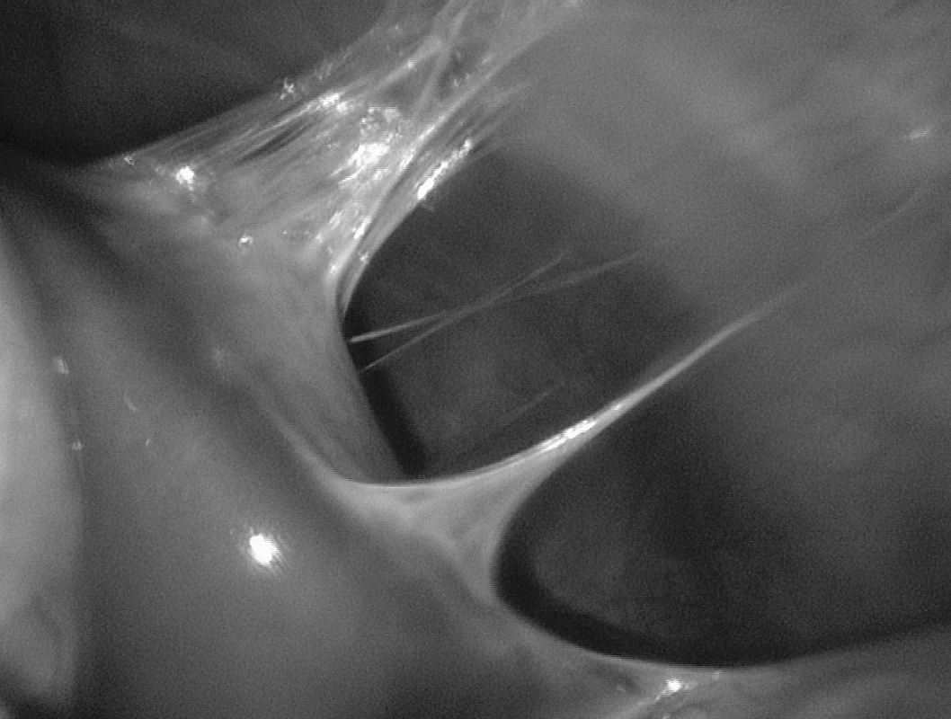 „Violin string“ adhézie pri perihepatitíde