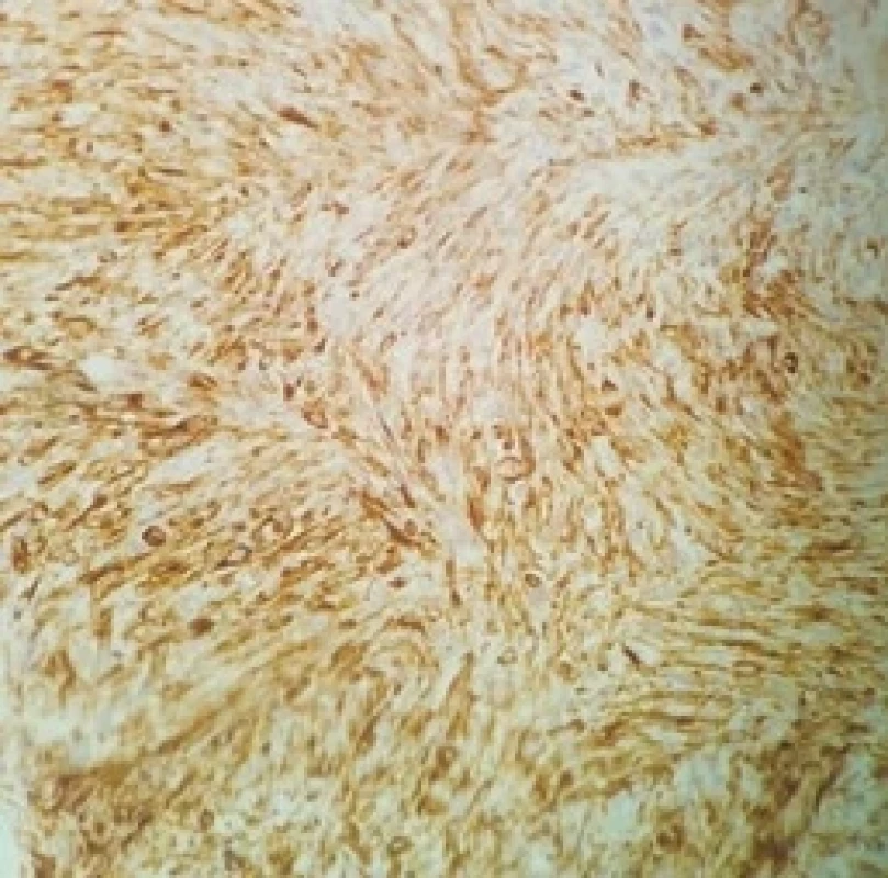Positivity for desmin is also evident among sarcomatous cells (20×).