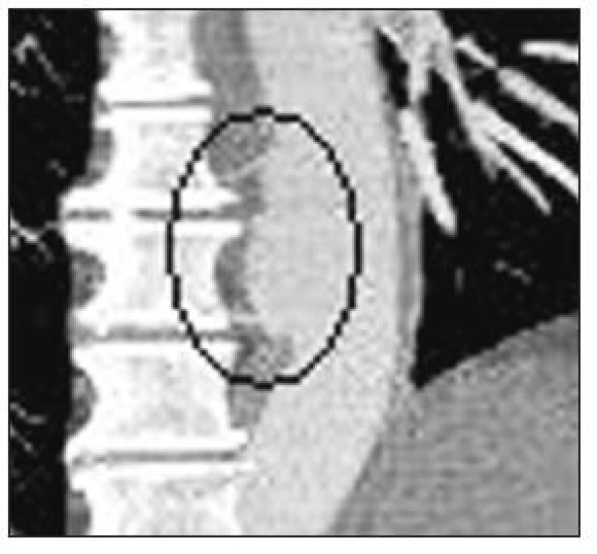 Reimplantace interkostálních tepen (CT-AG pooperační kontrola)
Fig. 10. Reimplantation of intercostal arteries (CT-AG postoperative assessment)
