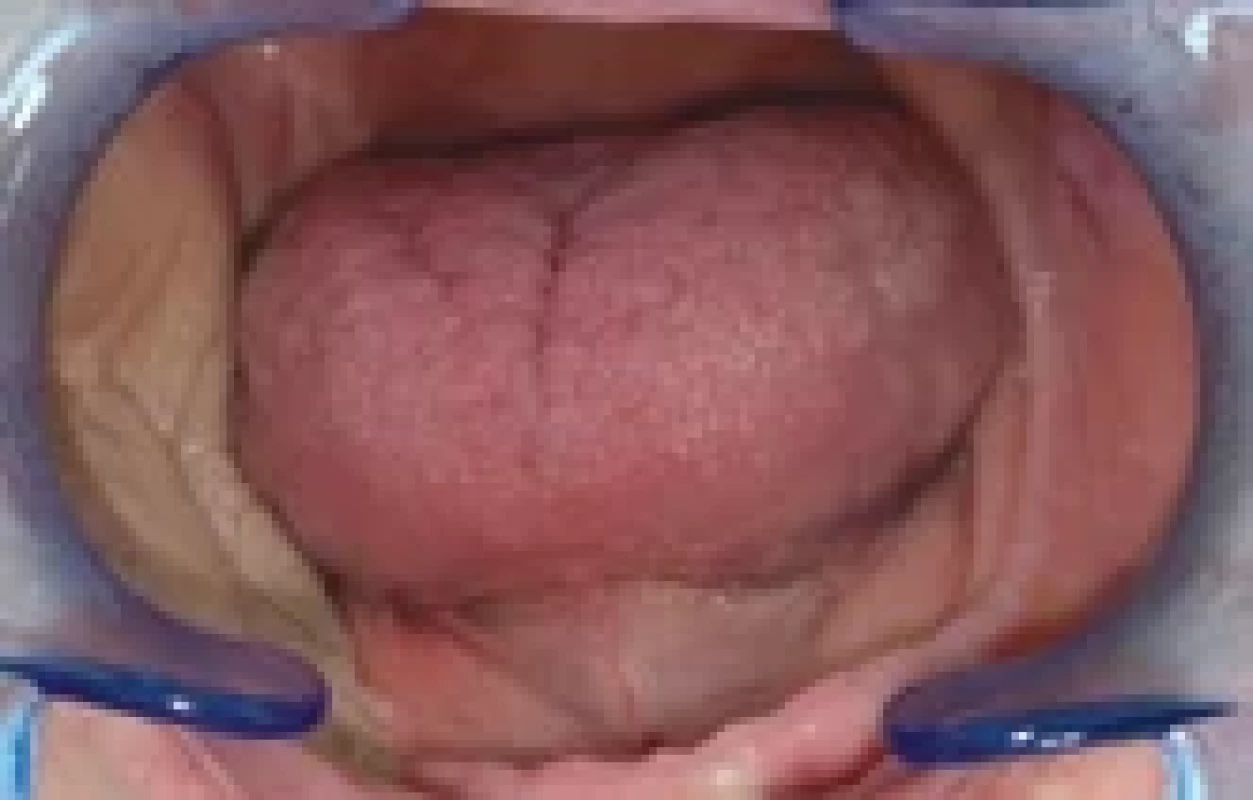 The radial forearm free fl ap 26 months after the reconstruction of the right buccal and retromolar region.