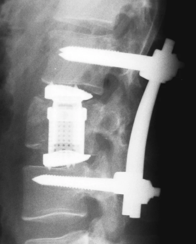 Implantovaný koš Synex, bočná projekce.
Pic. 4. Implanted Synex cage, lateral view