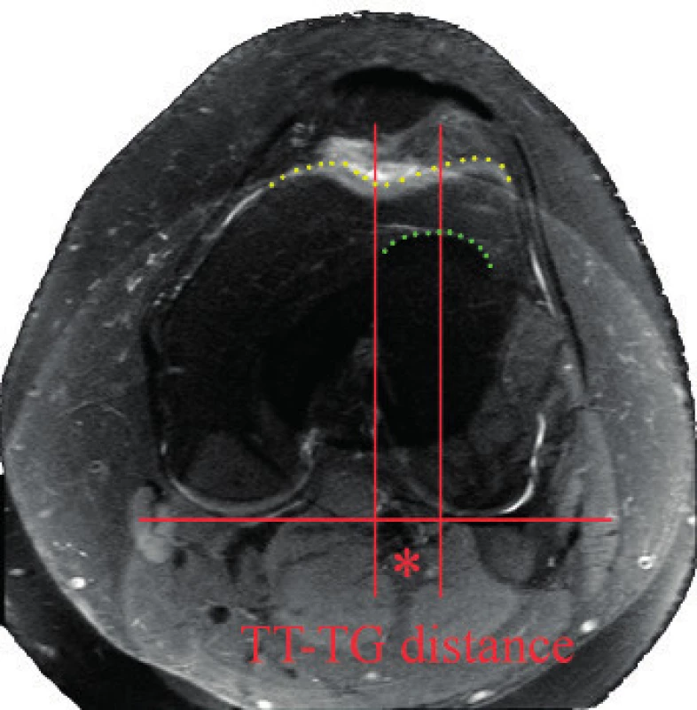 MRI sumace k hodnocení TT-TG distance – kontury trochley femuru a tuberosity tibie naznačeny, hvězdička určuje vymezení TT-TG distance.
Fig. 8. MRI summation to evaluate TT-TG distance – contours of the trochlea and tibial tuberosity marked, star mark showes TT-TG distance.