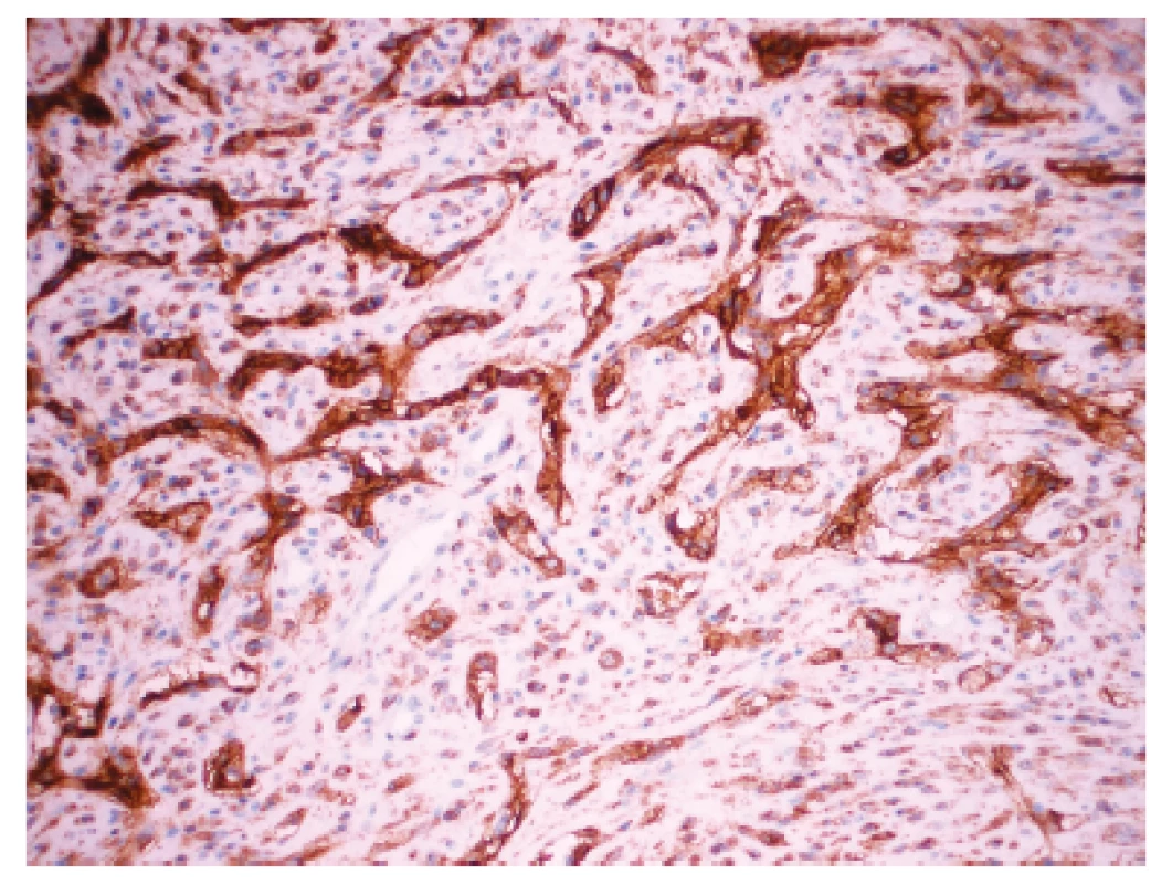 Imunohistochemický dokaz CD10 v nadorových bunkách. Zvačšenie 200x.