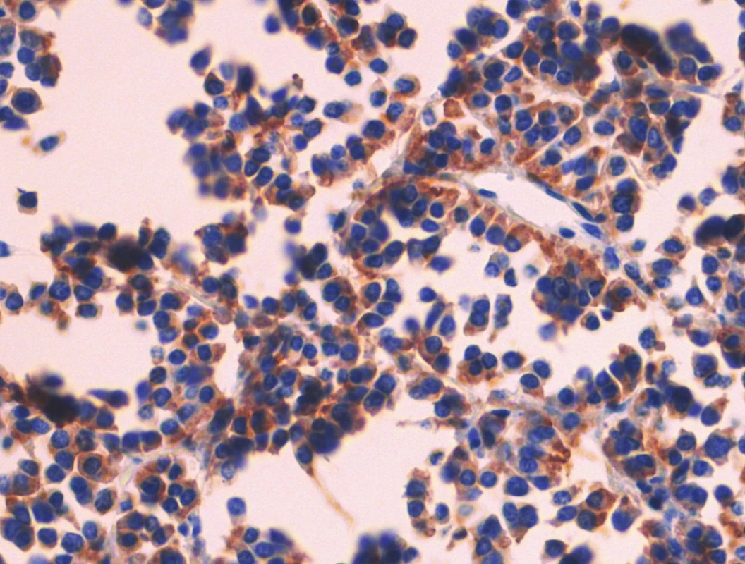 Pozitivní nález s protilátkou proti synaptofyzinu. Imunohistologie, 400x