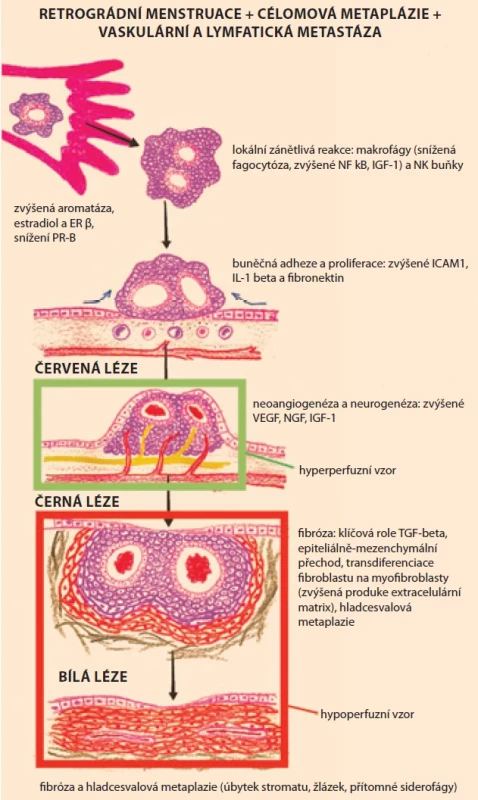 Patogeneze vzniku endometriální léze.