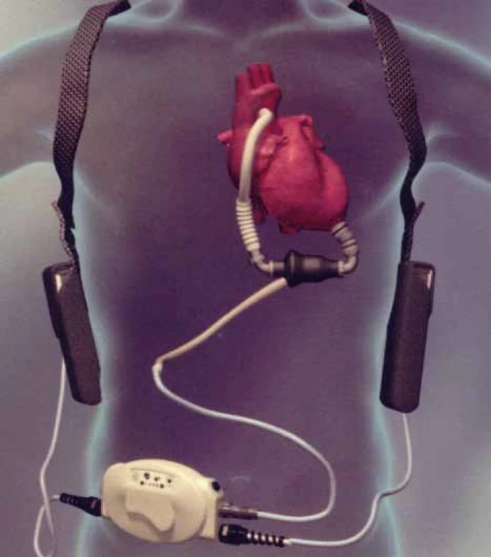 HeartMate II<sup>®</sup> LVAD (Thoratec<sup>®</sup> Corp., Pleasanton, CA, USA; www.thoratec.com).