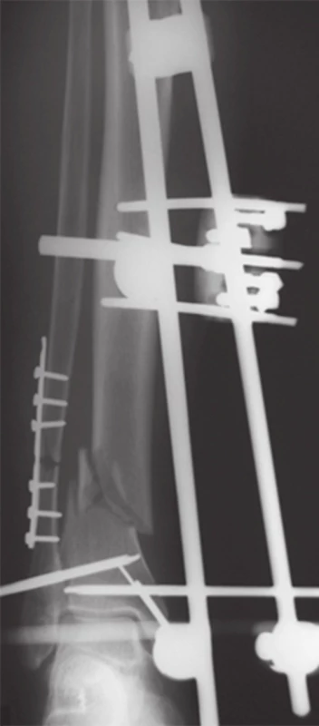 RTG ľavého predkoleniastabilizácia zlomeniny distálnej fibuly žliabkovou dlahou a fixácie zlomeniny distálnej tíbie vonkajším fixátorom
Fig. 6: Fixation of left tibial fracture with uniplanar external fixator, fibular fracture fixed with one-third tubular plate