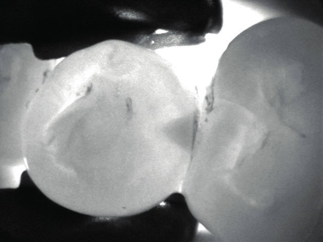 Sledování pomocí přístroje DiagnoCAM, kdy lze odhalit i počínající kazivé léze
