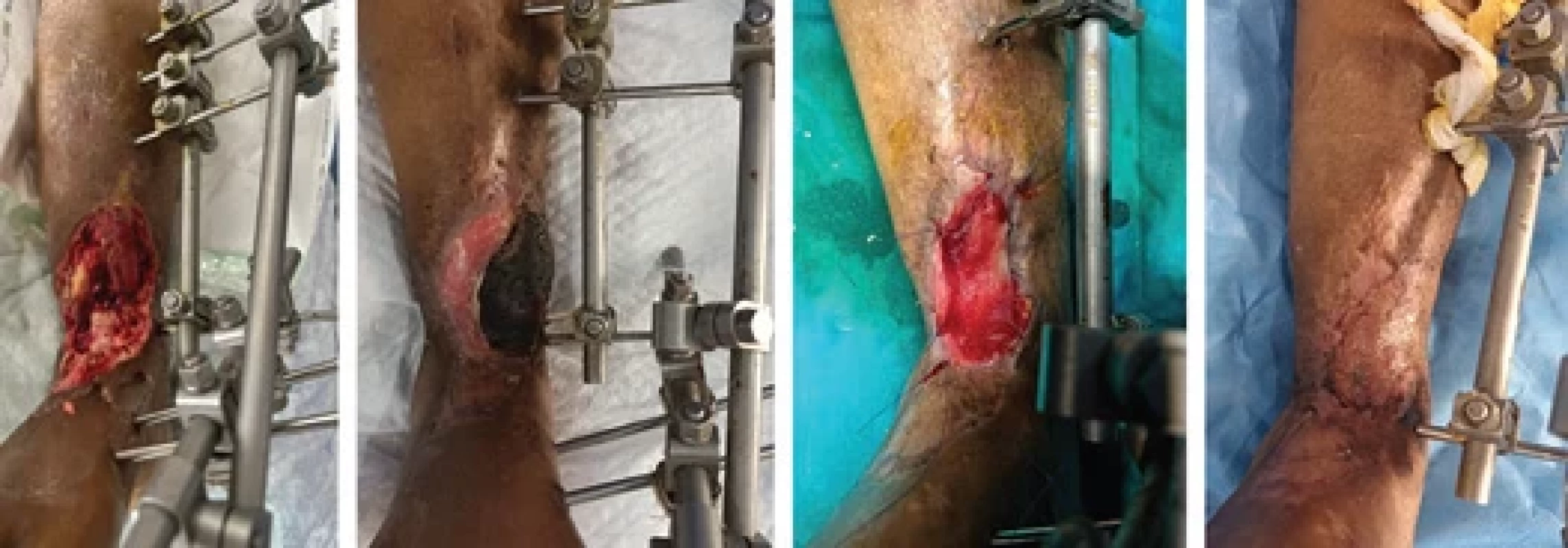 A 63-year-old female with monophasic arterial fl ow suff ered a distal third leg open type 3B fracture, both bones underwent cross-leg fl ap, which necrosed leaving a 7 × 4 cm ulcer with exposed tibia. The patient was treated with a matrix and SSG.