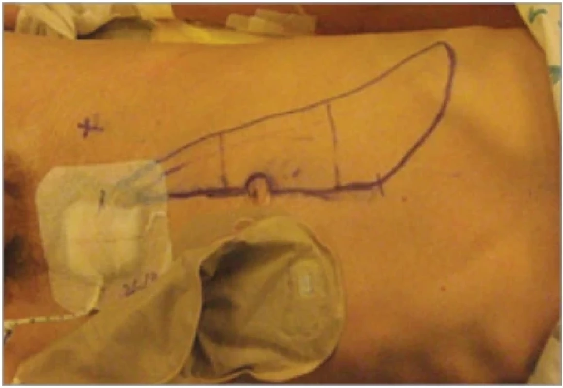 Patient 1 – preoperative skin markings, donor-site.