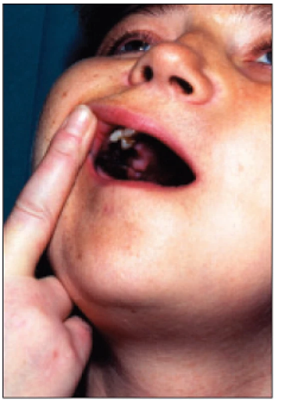Viditelný hnědý tumor v horní čelisti při terciární hyperparatyreóze.