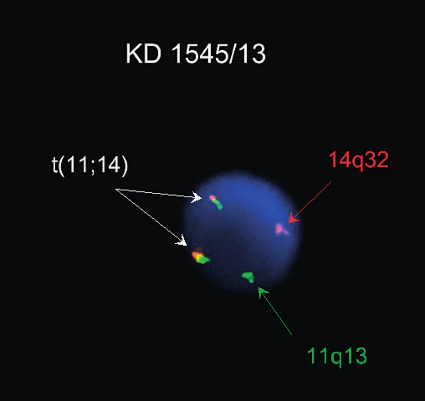 Lymfom z plášťových buněk, t(11; 14), FISH (sonda Kreatech ON BCL1/IGH t(11;14)Fusion), fúzní signály translokovaných chromozomů jsou vyznačeny šipkou
(Publikováno se souhlasem CGB laboratoře a. s.)