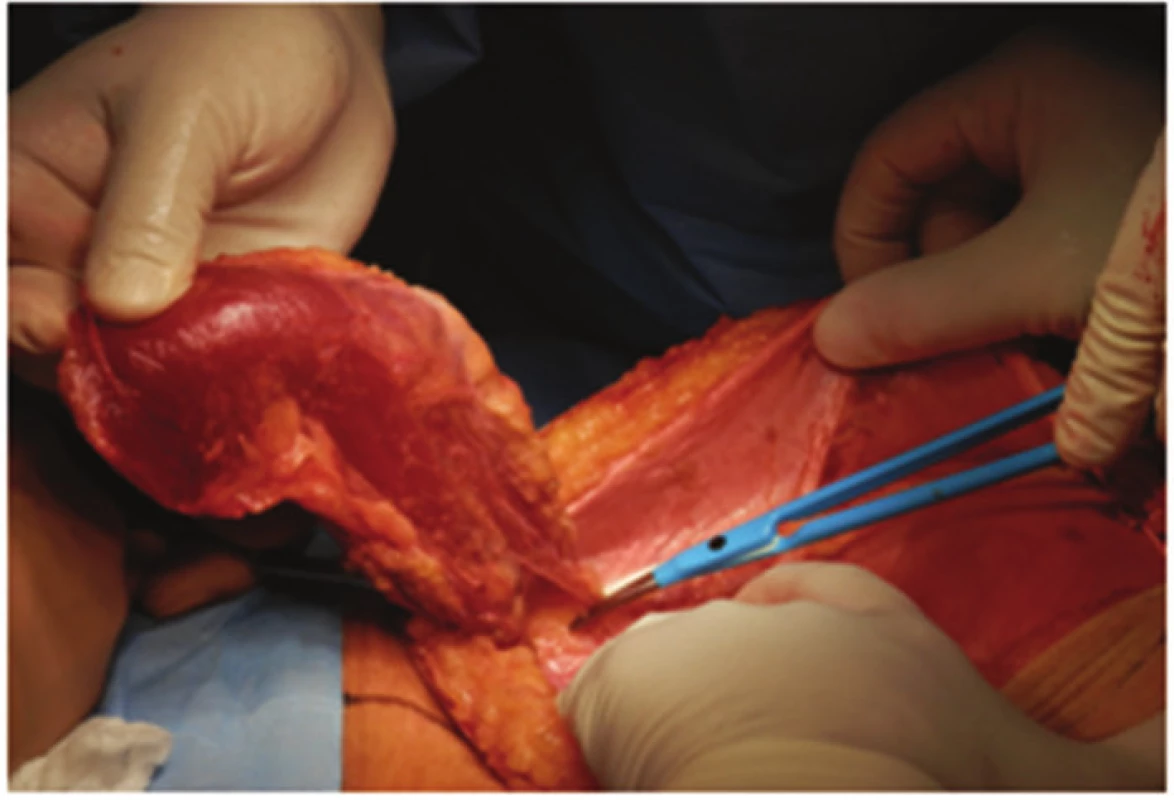 M.rectus abdominis na cévní stopce z kaudální strany po uvolnění ze svalové pochvy
Fig. 5: Rectus abdominis muscle pedicled inferiorly after releasing from muscle sheath