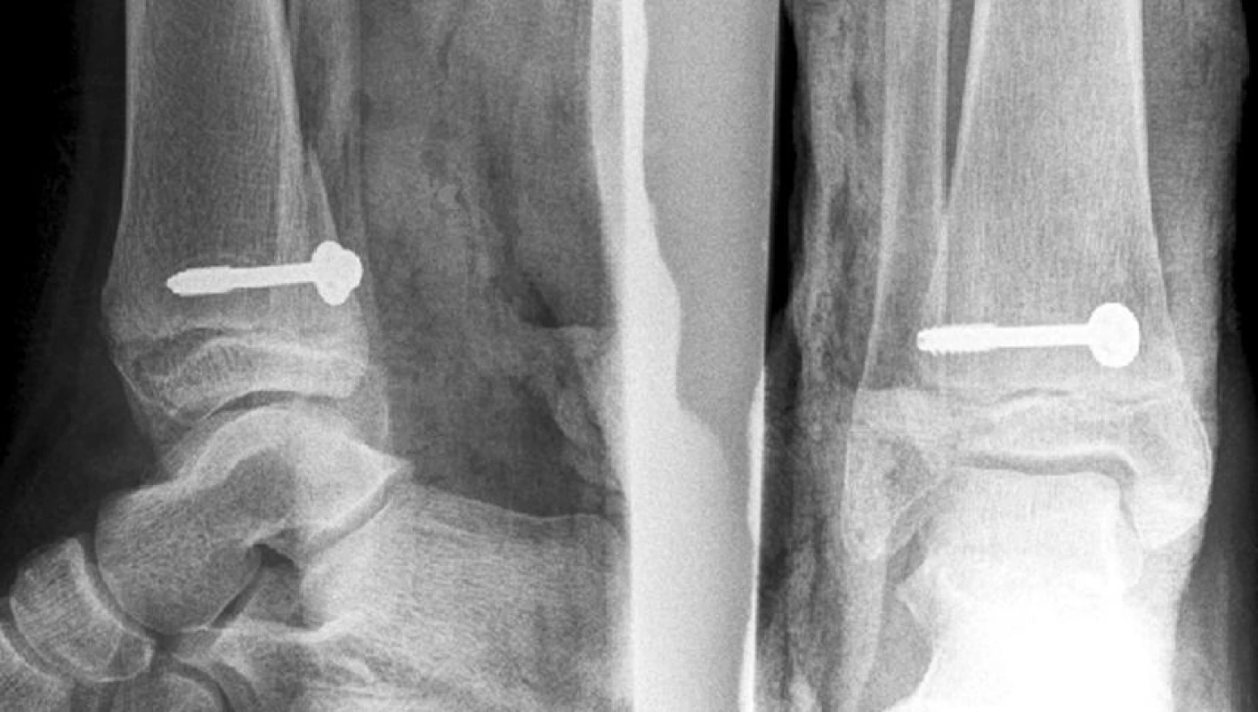 Osteosyntéza epifyzeolýzy distální tibie SH II tahovým šroubem