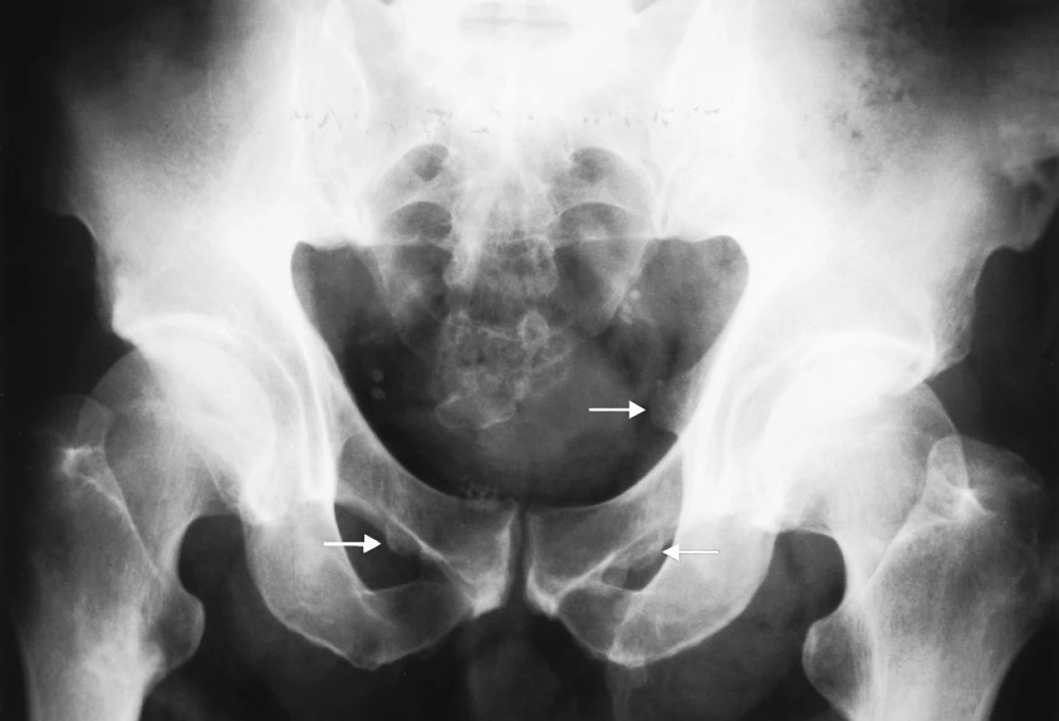 Fluoróza II.–III. štádium
Obvodové apozície foramen obturatorium vpravo (dolná šípka); zvýraznený úpon lig. sacrospinale (horná šípka)