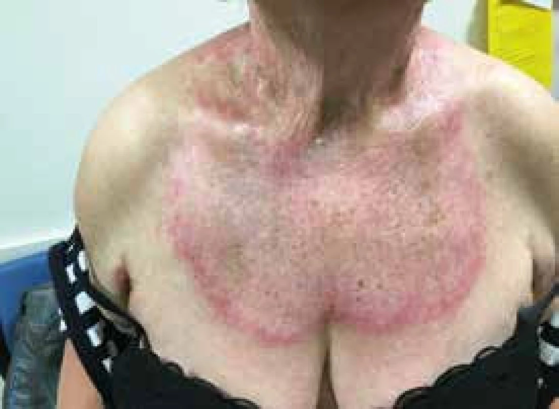 Červenofialová vyrážka na hrudníku se známkami aktivity, ale také se staršími změnami ve formě pigmentací kůže u nemocné s dermatomyozitidou