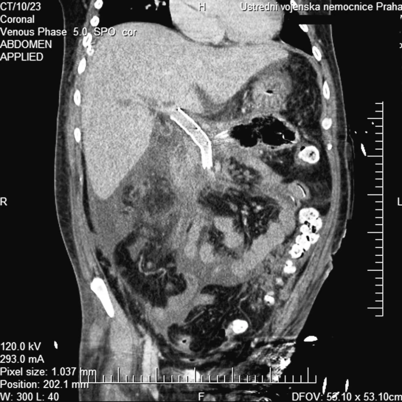 CT multiplanární rekonstrukce v koronární rovině a portální fázi prokazuje dobře uložený a volně průchodný stentgraft
Fig. 5. CT multiplanar reconstruction in the coronary plane and portal phase depicts the correctly positioned and patent stent