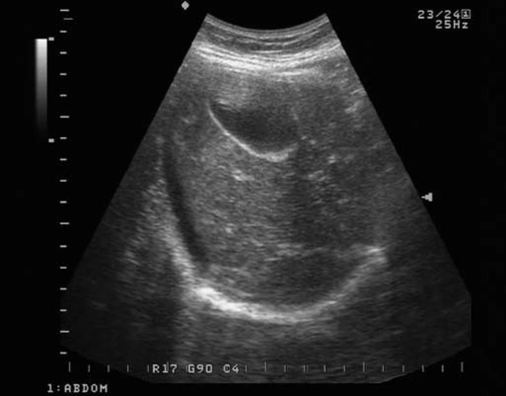 Sonografický obraz ascitu v okolí jater.
Fig. 1. Ascites close to liver in abdominal ultrasonography.