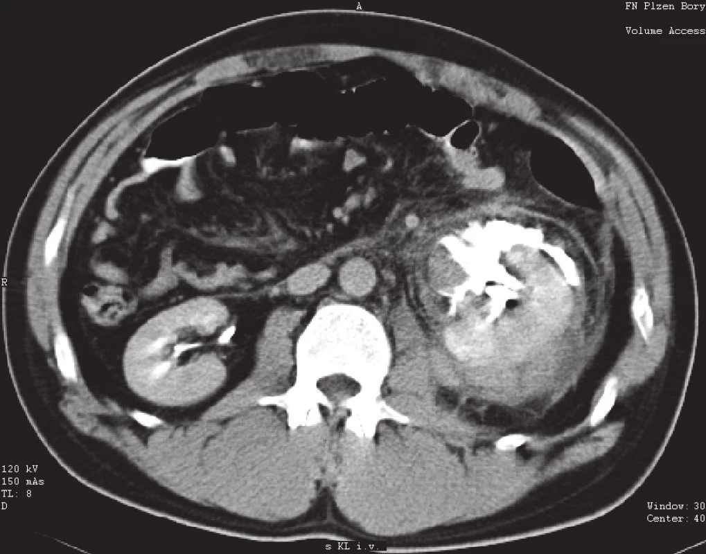 Únik kontrastní látky při poranění dutého systému levé ledviny – IV. stupeň poranění dle AAST, provedena nefrektomie vlevo
Fig. 2. Trauma of the collecting system of the left kidney with leakage of contrast medium – grade IV. renal injury by AAST, treated by nephrectomy on the left side