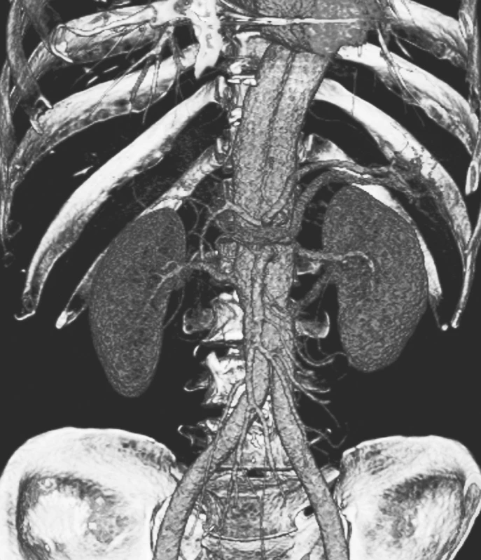 Detailní CTA obraz „double barreled aorty“ rok po resekci subrenální aorty technikou aortální fenestrace s ABI rekonstrukcí
Pic. 18. A detailed CTA view of the „double barreled aorta“ a year after the resection of the subrenal aorta using the technique of aortic fenestration with ABI reconstruction