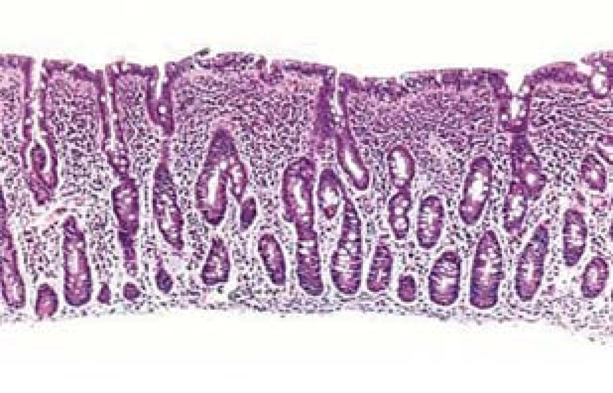 Částečná atrofie klků – typizace Marsh 3a, barvení hematoxilin-eozinem dle [17].
Fig. 1. Partial atrophy of the villi – Marsh 3a typing, haematoxylin-eosin staining according to [17].