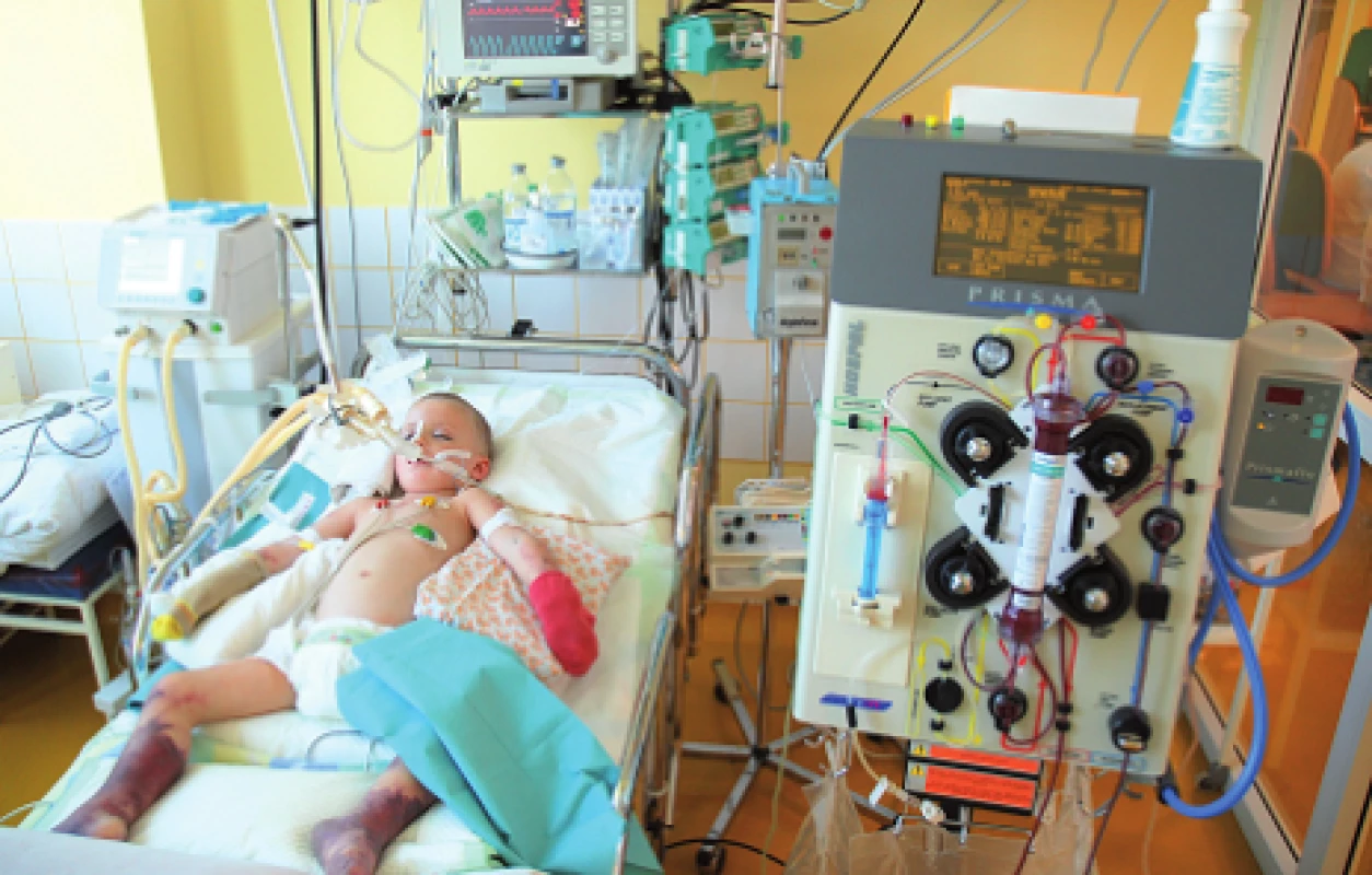 CVVHDF (kontinuálna veno-venózna hemodiafiltrácia) u kriticky chorého dieťaťa.
Fig. 2. CVVHDF in critically ill patient.