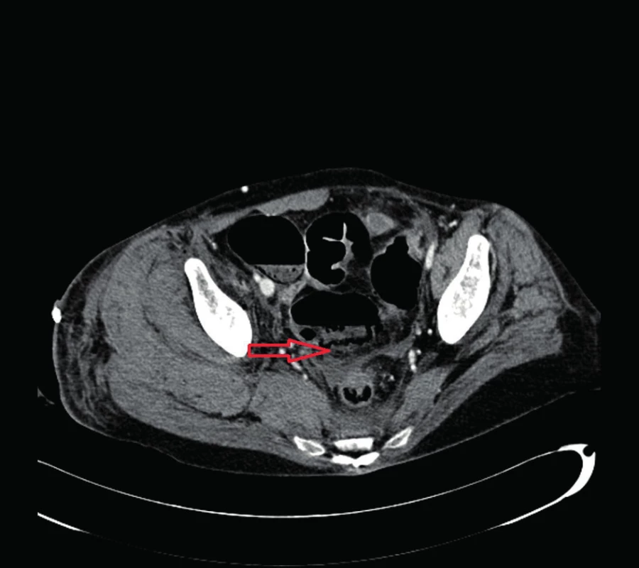 Pnematoza steny céka a sigmy
Fig. 4: Pneumatosis of the wall of the caecum and the sigmoid colon