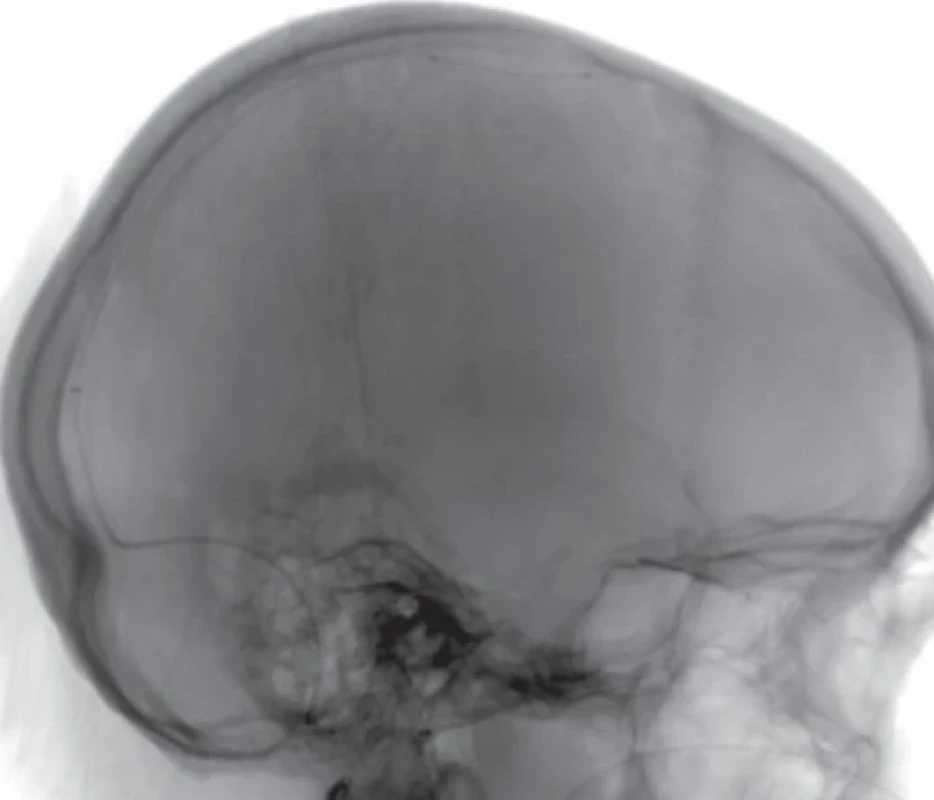 Digitální subtrakční angiografi e s polohou mikrokatetrů pro trombolýzu.