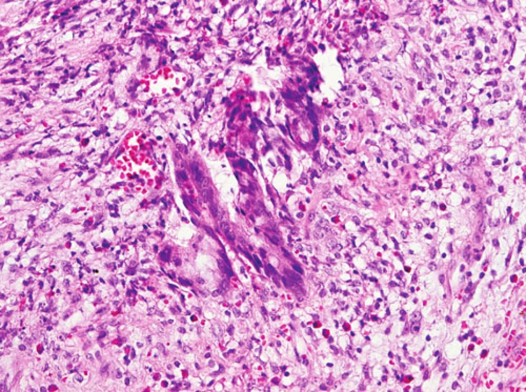 Nádorové žlázky infiltrující stěnu apendixu (HE, 240x)
Fig. 4. Tumor glands infiltrating the appendiceal wall (HE, 240x)