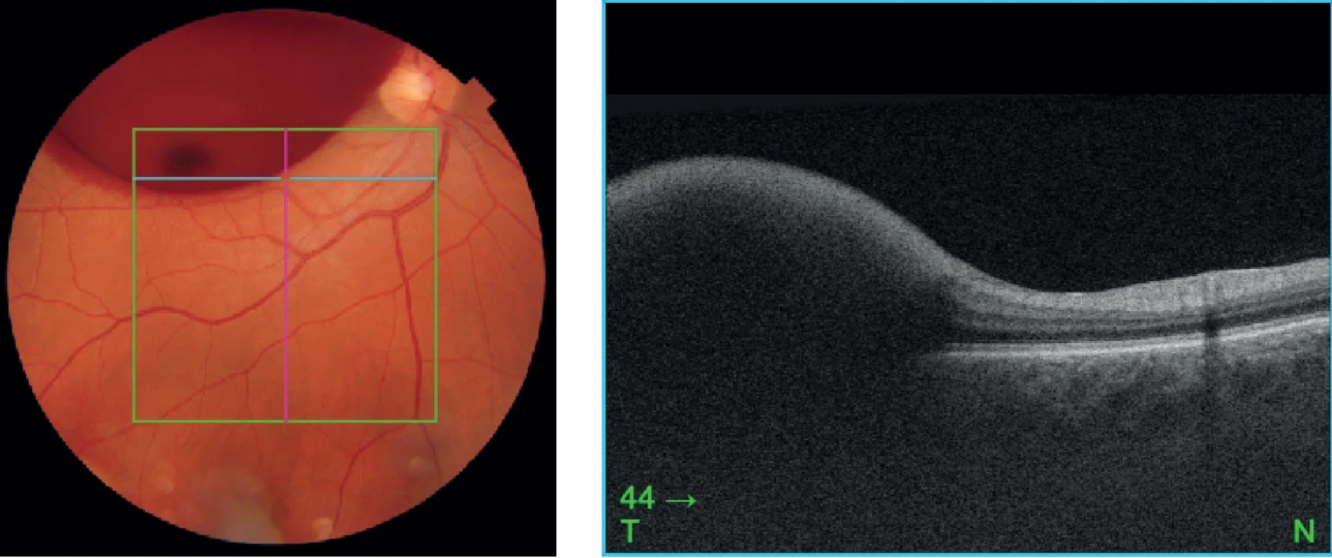 Photo documentation and optical coherence tomography (OCT) of the fundus