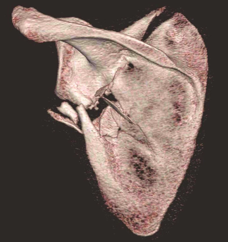 Třídimenzionální CT rekonstrukce – pohled z dorzální strany - Stejný případ jako na Obr. 1
Fig. 2: Three-dimensional CT reconstruction – posterior view - The same case as in Fig 1