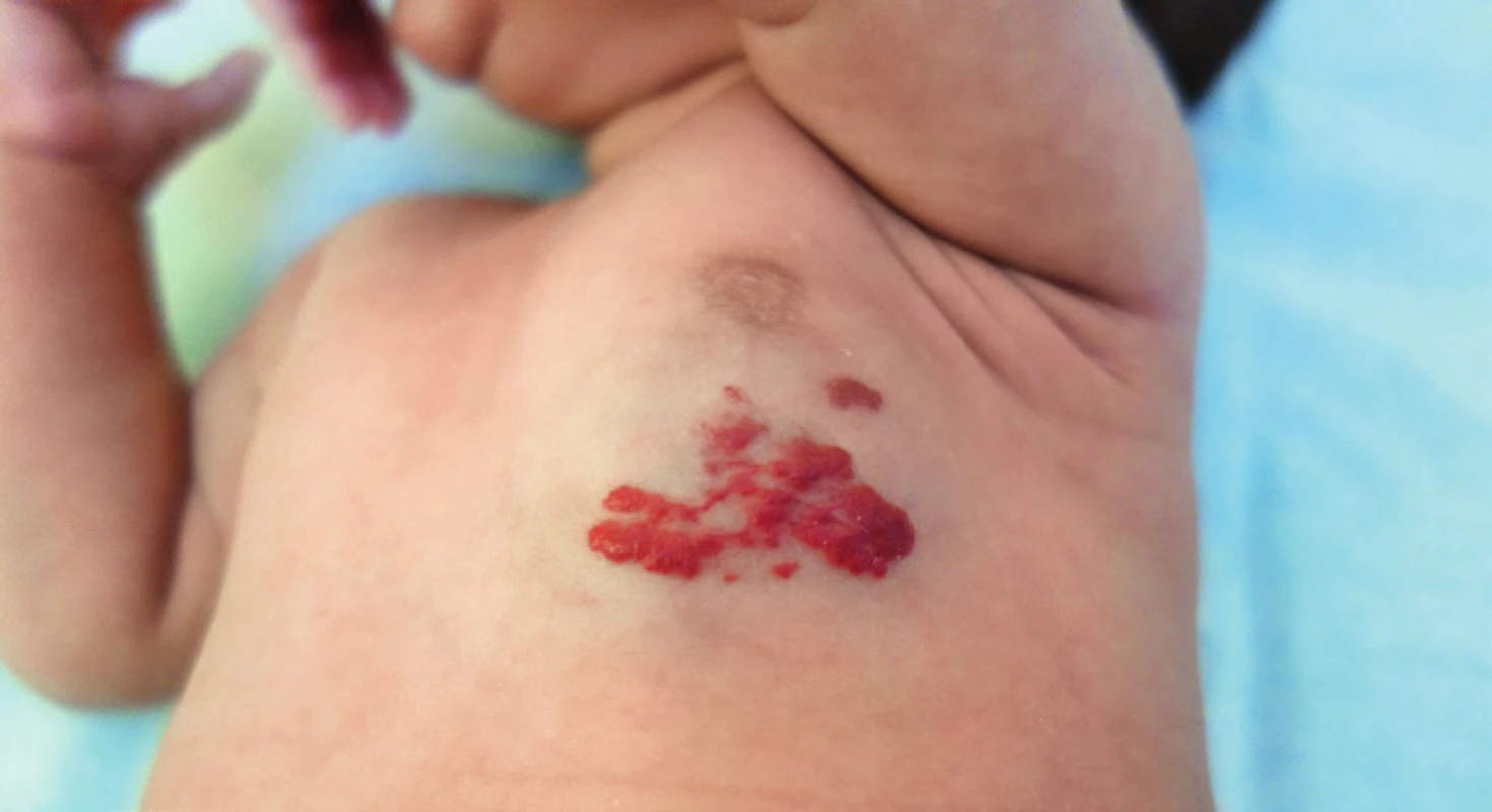 Smíšený hemangiom.
Fig. 3. Mixed hemangioma.