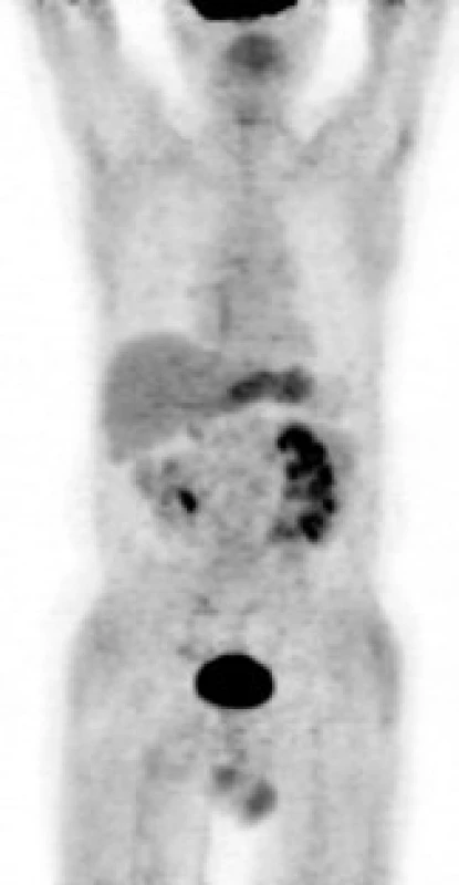 <sup>18</sup>F- FDG PET – MIP: hypermetabolizmus glukózy v retroperitoneu neprokázán. Nález odpovídá metabolické remisi. Přiměřená aktivita v ledvinách a močovém měchýři při vylučování radiofarmaka.