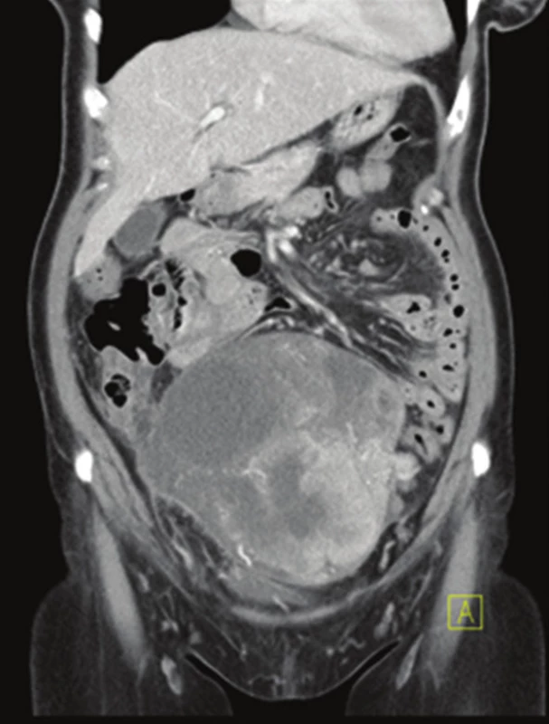 CT obraz objemného metastatického postižení pravého ovaria (venózní fáze – koronární řez)
Fig. 1: CT scan of large metastatic involvement of the right ovary (venous phase – coronal view)